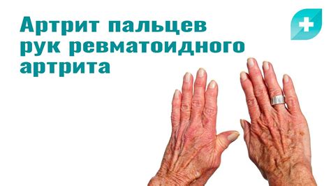 Ревматоидный артрит - почему болят суставы рук?
